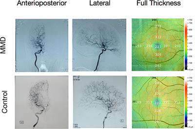 Investigation of Altered Spontaneous Brain Activities in Patients With Moyamoya Disease Using Percent Amplitude of Fluctuation Method: A Resting-State Functional MRI Study